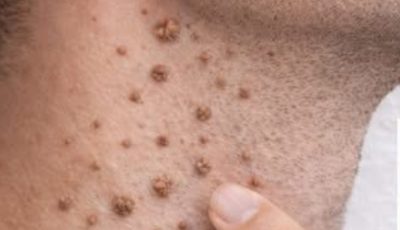 Banana Peel for Skin Tags or Warts: What You Should Know