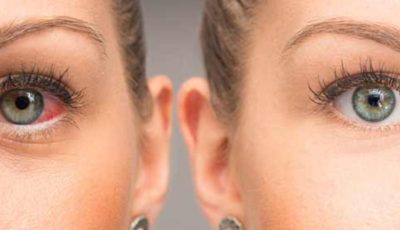 The Benefits of Castor Oil for Eye Health