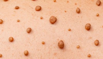 Natural Wart Remedy: Garlic & Apple Cider Vinegar Treatment