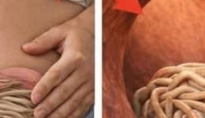Garlic eliminates parasites in just 1 day? What you really should know before trying it