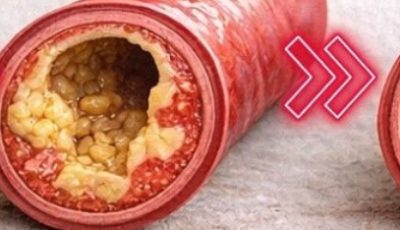 Say goodbye to blocked arteries with these powerful foods