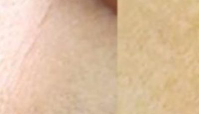 Erased My Age Spots With a Cheap Kitchen Ingredient: Baking Soda