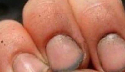 What do you call a person who has nails like that