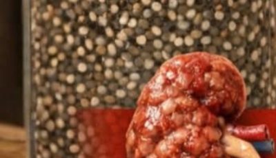 Discover This Simple Daily Habit: Flaxseed and Honey for Gentle Kidney Support