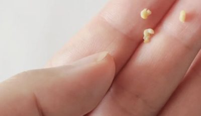 Here’s What You Need to Know About Tonsil Stones