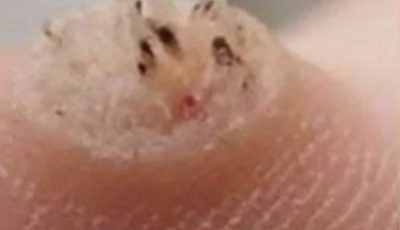 6 Types of Warts (Signs, Symptoms, Home Remedies, and Treatment)