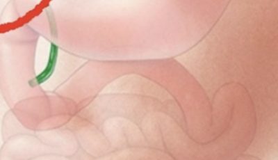 What Happens to the Body After Gallbladder Removal? 3 Diseases That May Follow – Avoid Surgery If Possible