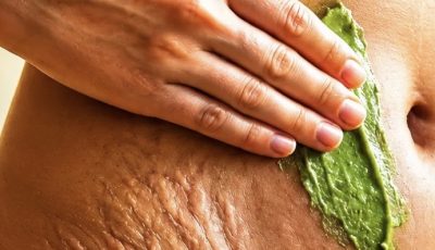 Stretch Marks + The Skin-Rebuilding Secret Hidden in Plain Sight